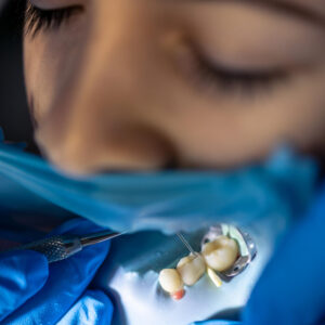 Implantes Dentales
